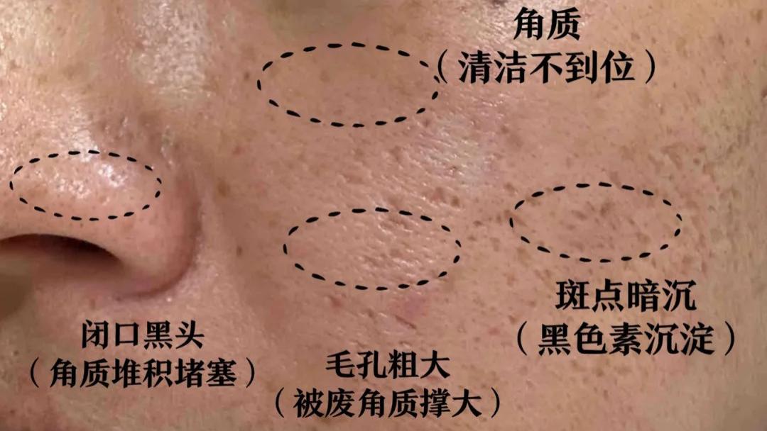 毛孔粗大分4种！对号入座才能救！