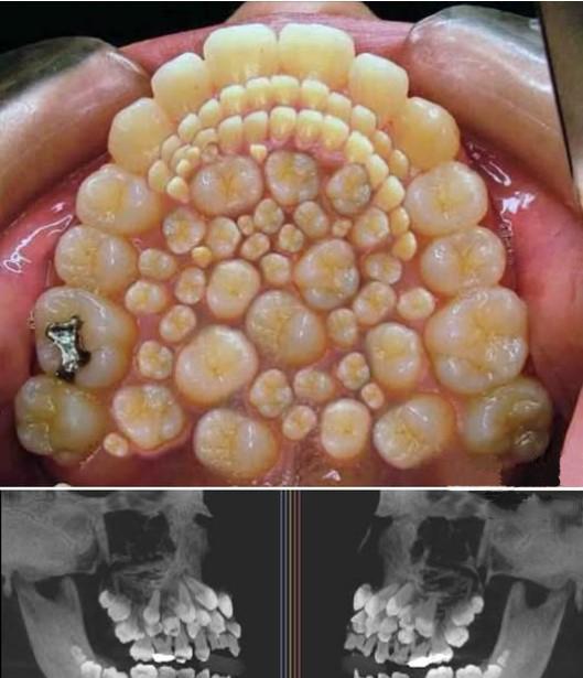 多牙症（hyperdontia）是指口腔中出现多于正常32颗恒牙（或多于20颗乳
