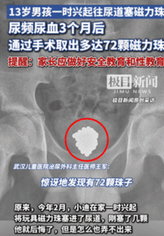 “性教育的重要性！”武汉，13岁男孩往尿道塞入72颗磁力珠，因担心父母责怪，竟尝