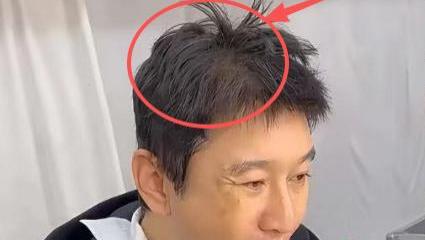 这才是真实状态下的黄晓明，不戴假发的他头发稀疏脱发严重！