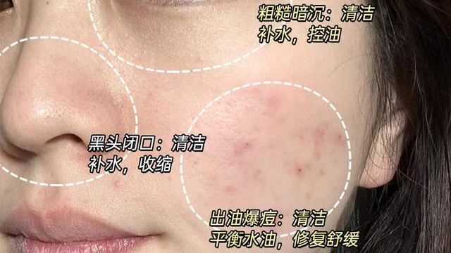 毛孔粗大救星！天然成分竟能收缩毛孔？