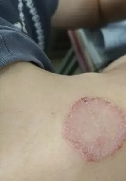 广西，一名女子总觉得脖子后面非常痒，但是看不见，只能不停地抓。一天，她实在痒得受