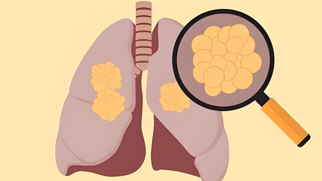 查出结节、囊肿不要慌！一个传了300年的中成药，帮你清肝火、散硬结、消囊肿！