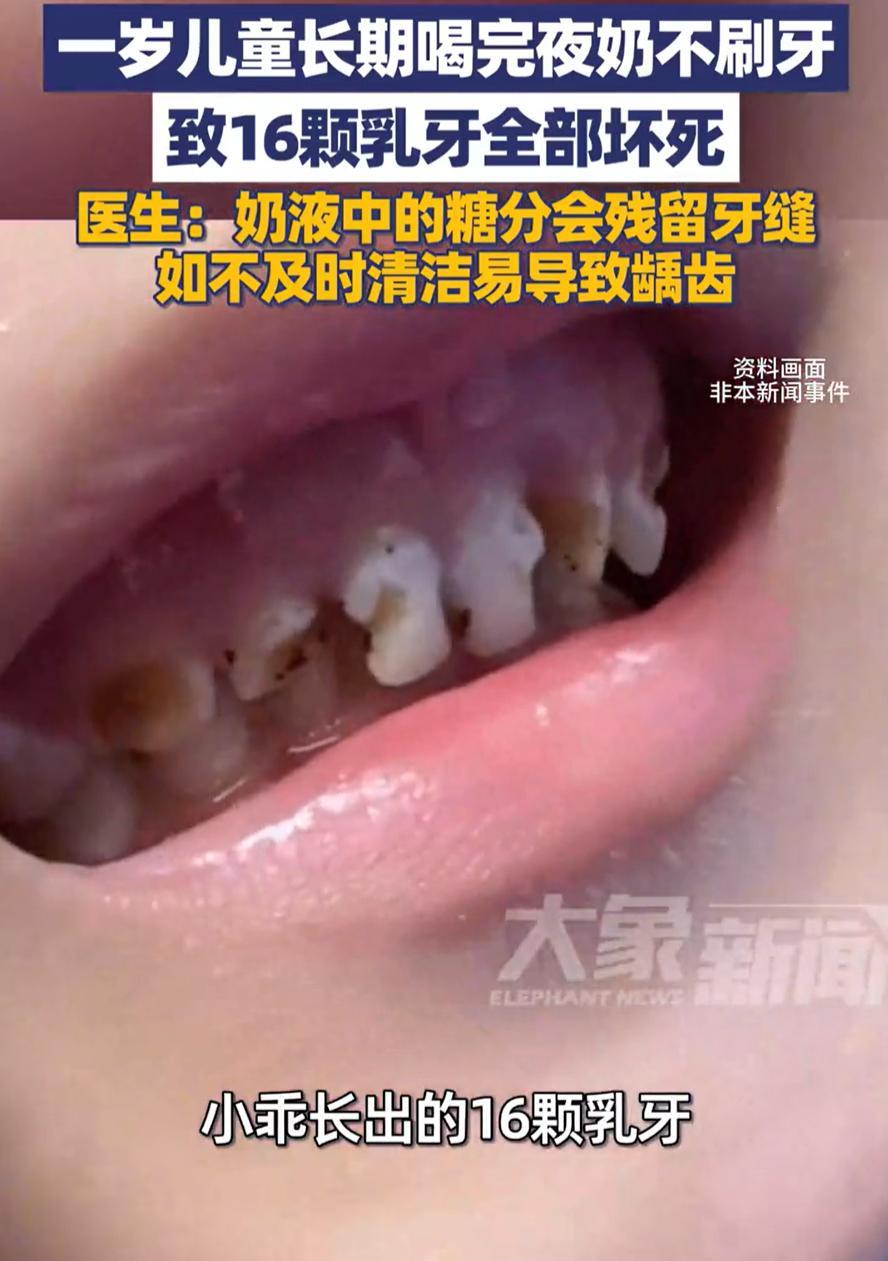 “万万没想到！”浙江杭州，一岁多的宝宝嘴里16颗乳牙全都坏了，带到医院一查，连里