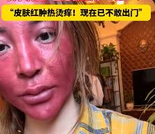 “太吓人了！”吉林37岁高女士，15岁开始化妆，二十多年化妆不卸妆！导致女子满脸