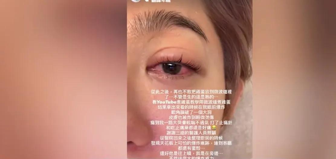 女演员王晴微波炉煮蛋炸伤眼！医生警告：这些操作千万别试！
网友震惊：