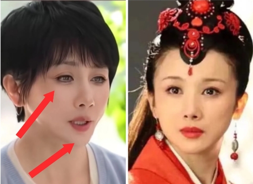 大家相信吗？
孙菲菲说，她面容大变
不是整容失败，是得了一种怪病名叫：库欣综合症