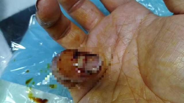 兰州一理发店老板被城管咬伤手指