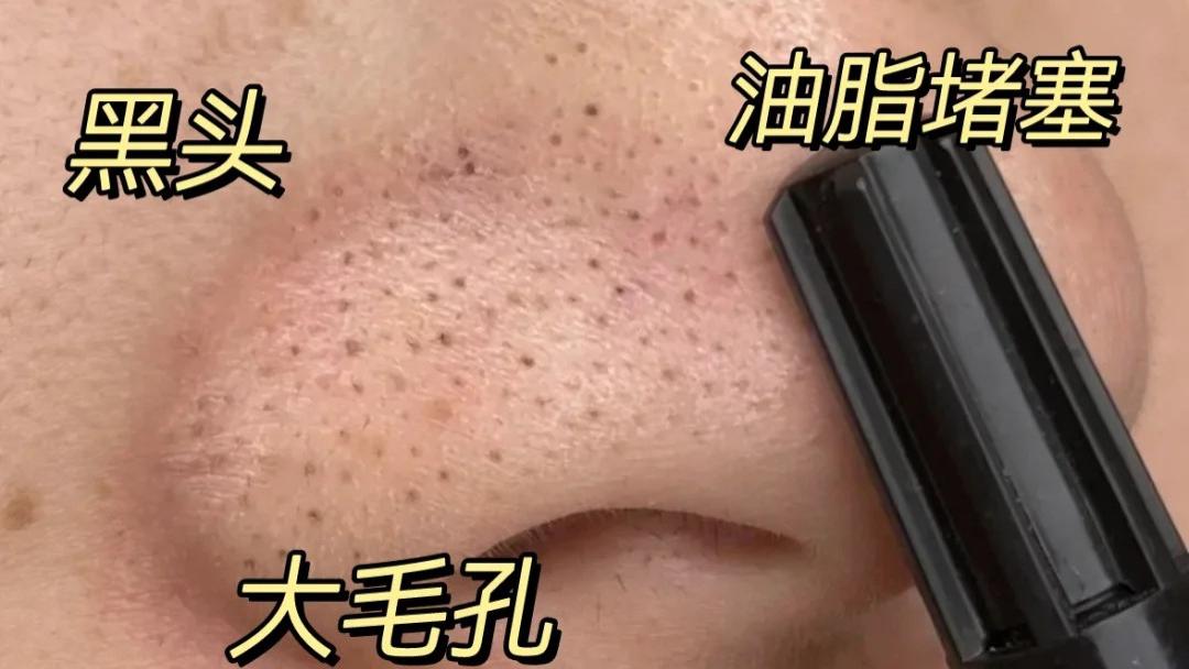 毛孔粗大是不可逆的吗？