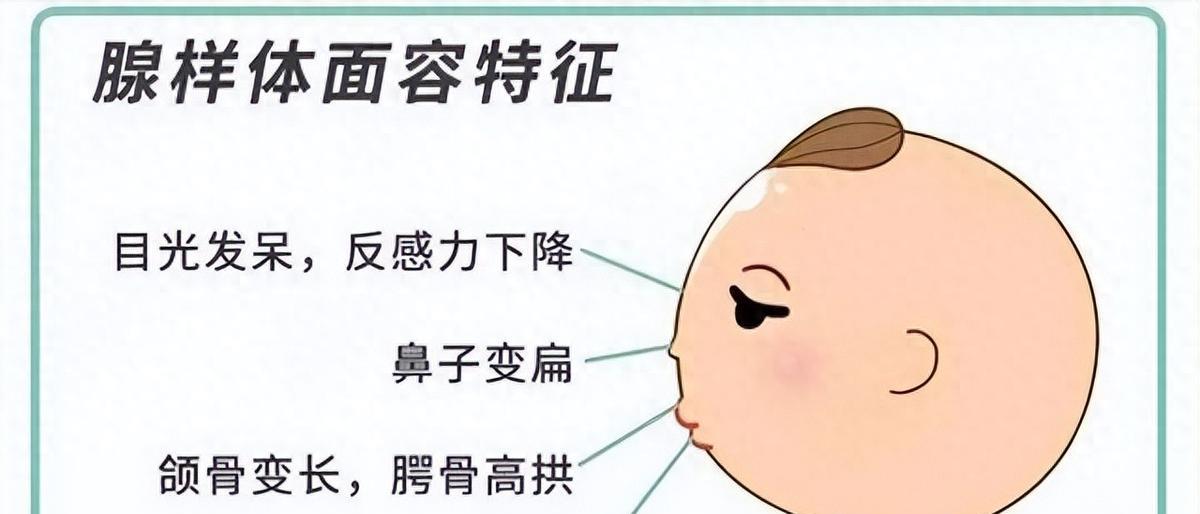 医生：孩子必须动刀！
80%父母还不知道第三条路
鼻炎拖久了，腺样体长期肿大，孩