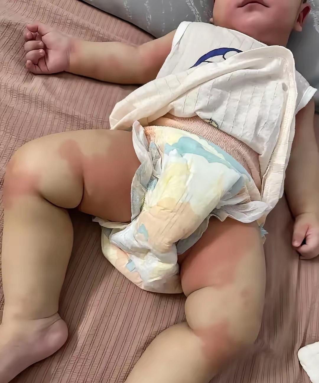 急哭！9月龄宝宝半夜突发红疹，
我家9月龄宝宝昨晚喝完奶还好好的，
睡下没多久就