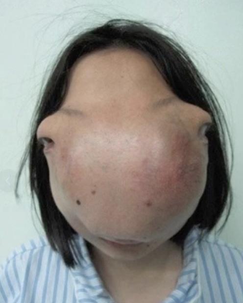 2009 年，22 岁浙江女孩因长了一张怪脸，蒙面生活 13 年后，好不容易凑够