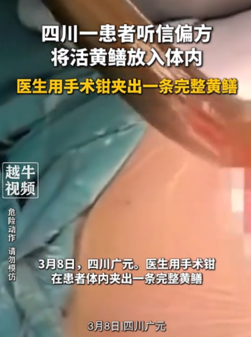 3月8日，四川一名男子轻信偏方，将一条活生生的黄鳝整个塞入体内。结果他很快便腹痛