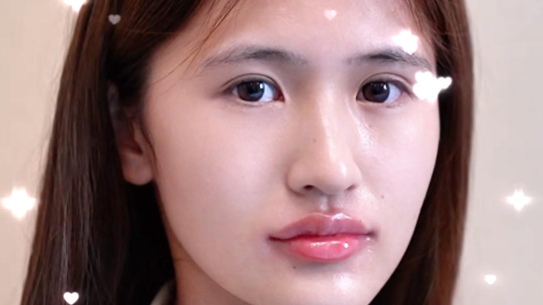 玻尿酸注射唇部效果如何？张敬花案例：干瘪唇秒变饱满果冻唇