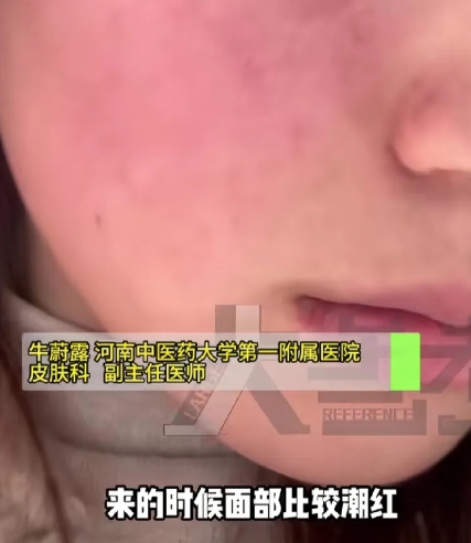 脚气”长到脸上是一种什么体验?6月18日，河南郑州一对夫妻在医院皮肤科看诊，两人