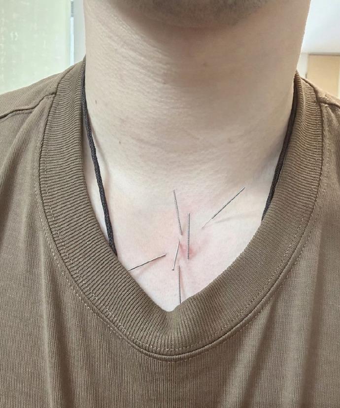 赵继伟头上和脖子上扎了这么多针，看来治疗嗓子也是非常艰难的过程啊！赵继伟上个赛季