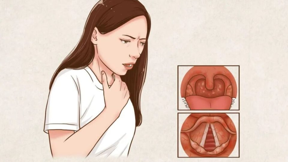 武汉民生耳鼻喉康国良主任提醒：每天一杯咖啡“续命”，喉咙不适老反复？小心是胃酸在 “灼烧” 咽喉