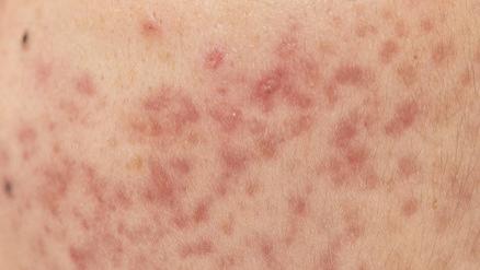 《你也可以优雅健康地生活》第二章，治疗痤疮的食疗方子