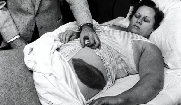 1954年，美国一女子正在睡觉中，突然感觉腹部和大腿被什么东西蹭着了一样，疼痛难