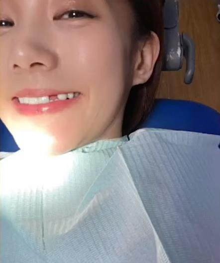 #李一桐被磕掉了一颗牙# 娱乐圈双璧之一，笑眼女神李一桐在节目里自曝拍打戏被撞掉