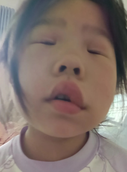 一大早就被孩子吵醒，她说自己的嘴巴肿了。
我赶紧起来查看，还真是嘴巴又肿又歪。