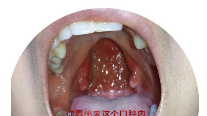 谈谈眼疾和刀片嗓的艾灸调理