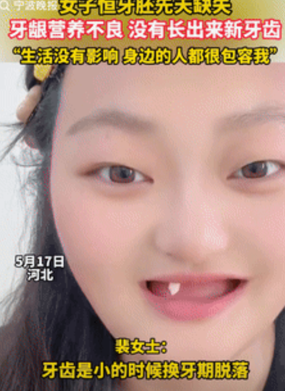 心理素质强的可怕！河北，一女孩小时候牙齿不停脱落，检查后得知她没有恒牙胚，所以长