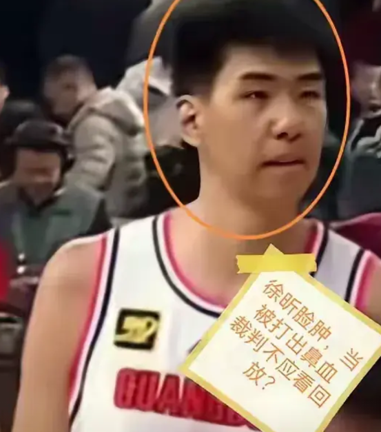 徐昕鼻青脸肿流鼻血，被山西球员打成什么样了啊？徐昕是北京孩子，他有素养有人品，他