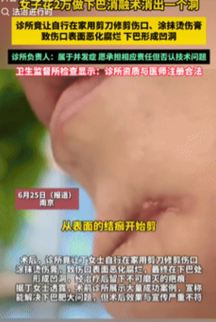 这种女人蠢得没眼看！江苏，一女子很爱美，花了20000块在美容所做了“下巴消融术