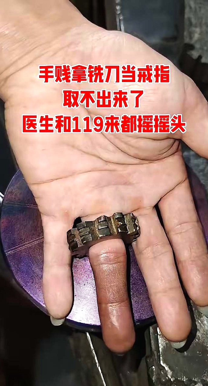 “戒指卡手，医生摇头，119无奈”😨💍👐 手贱拿铣刀当戒指，取不出来了，医