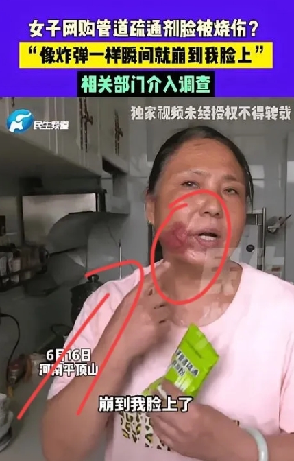 用管道疏通剂差点毁容？

河南平顶山的王女士可给大家提了个大醒！

按说明书倒疏