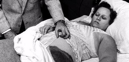 1954年，国外一女子正在熟睡中，突然感觉腹部和大腿被什么东西烧着了一样，疼痛难