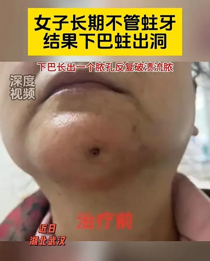 遇到这种情况必须慎重对待！近日，湖北武汉一位56岁女子由于长了蛀牙没有及时医治，