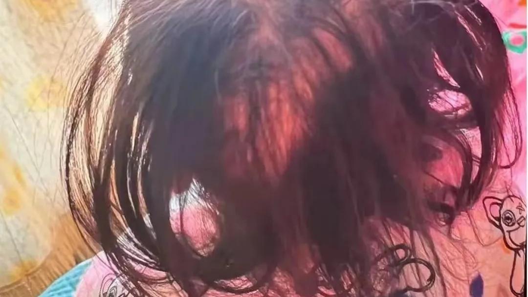 3岁女童头发一抓掉一把，竟是身边人下毒！医生痛心：这种症状太容易被忽视