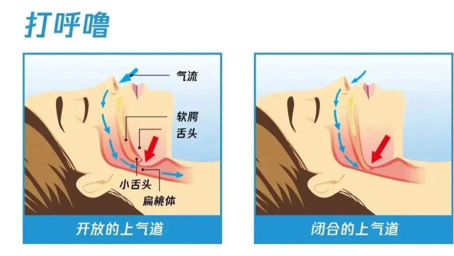 武汉民生耳鼻喉：著名演员戴呼吸机睡觉冲上热搜！打鼾不是睡得香，可能是病！