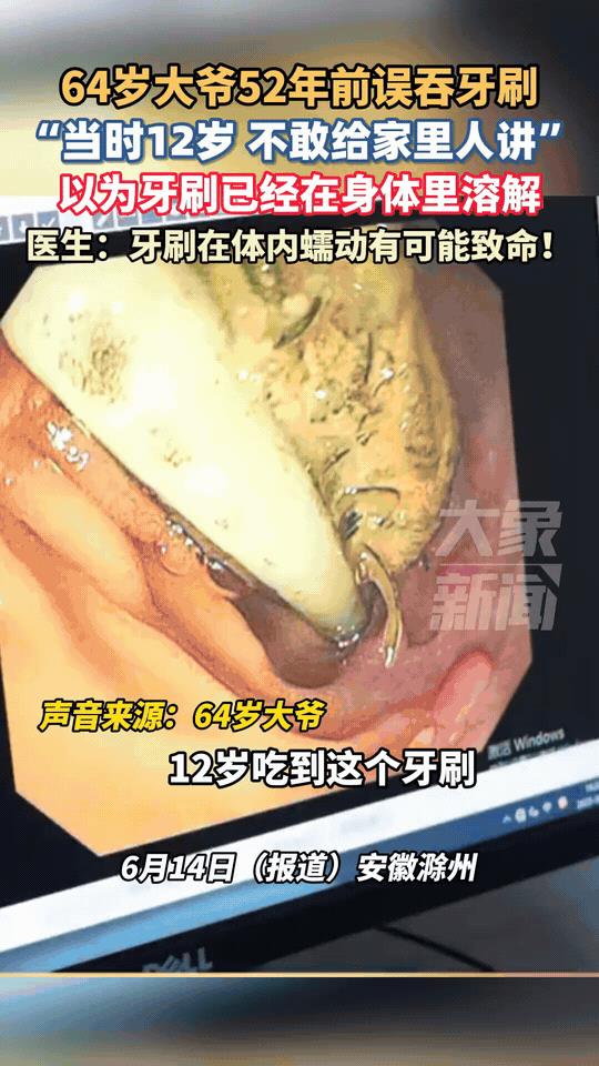“太离奇！”安徽，64岁大爷因胸口不适去医院检查，竟揪出体内埋藏52年的“陈年牙