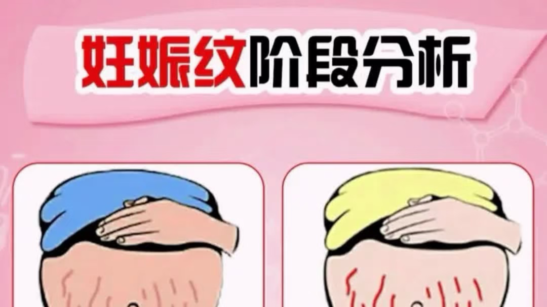 我讨厌妊娠纹，但我更爱它带来的你