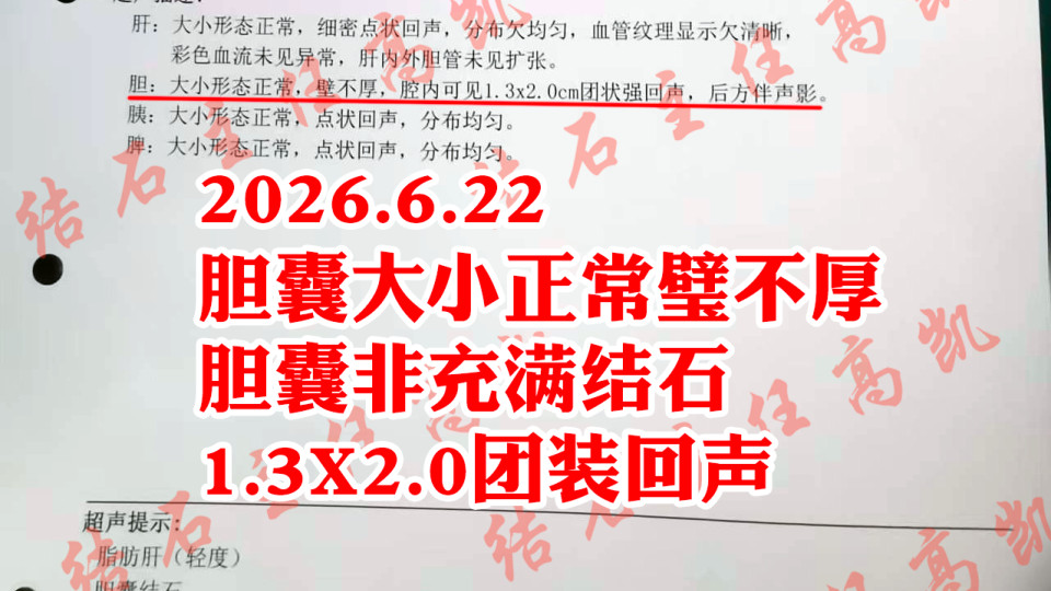 充满型结石