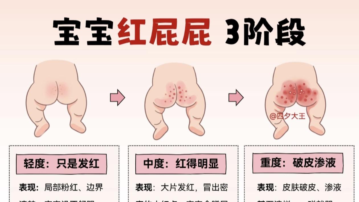 宝宝红屁屁反反复复好不了？原来是你一直都护错了方向