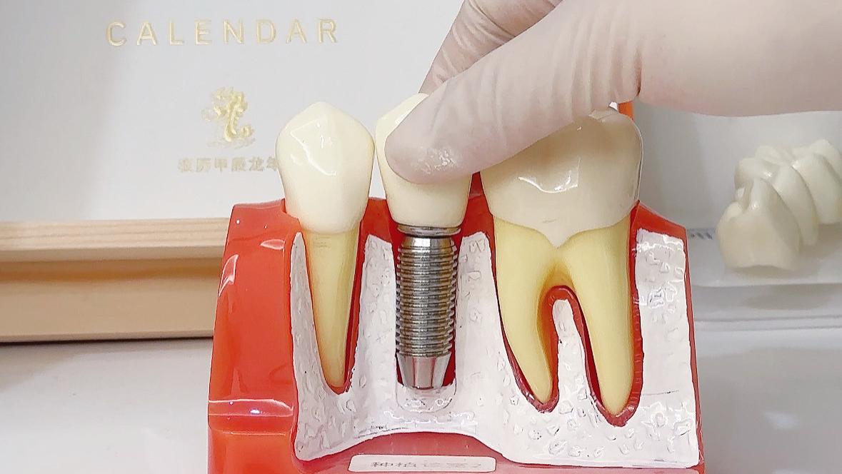 种植牙全揭秘：几次就诊？多久种好？一篇看懂
