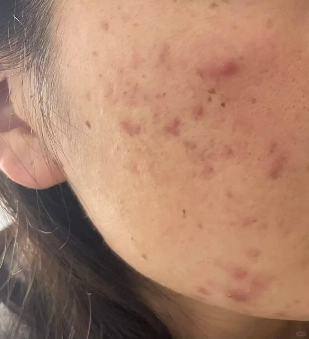 好用的去黑头泥膜 12 天搞定顽固性黑头，亲测巨有效