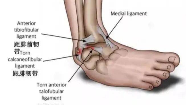踝关节扭伤的病因、分类以及治疗和康复训练