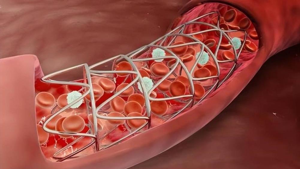 越累越心慌？别硬扛！这不是累着了，是血管在给你“报信”