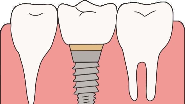 春节快到了，现在种牙来得及吗？牙医：别赶，但可以做这件事