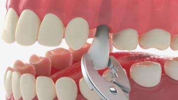 为什么拔牙正畸能让您既排齐牙齿，又变好看？