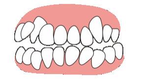 为什么牙齿拥挤的人，更容易出现牙龈萎缩和松动