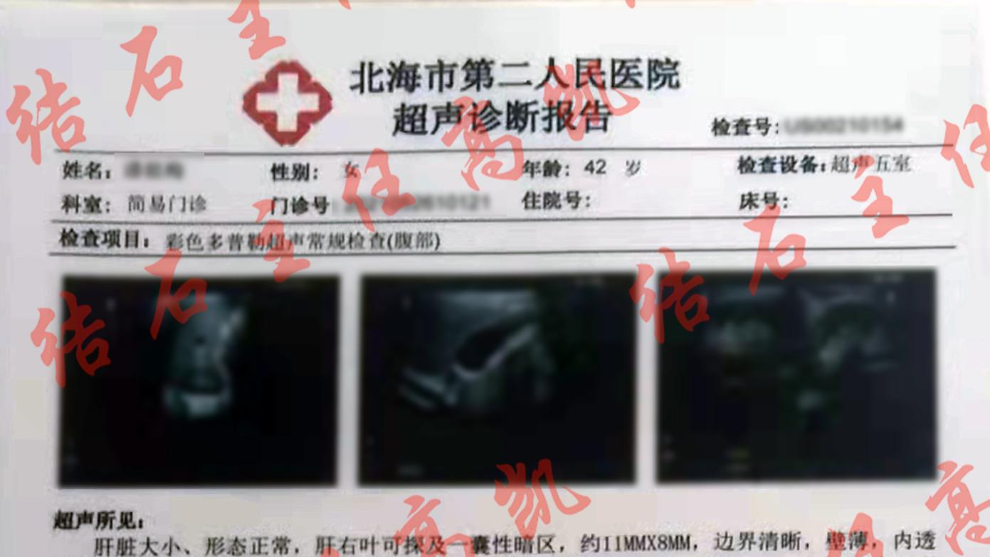 泥沙样结石11X4毫米
