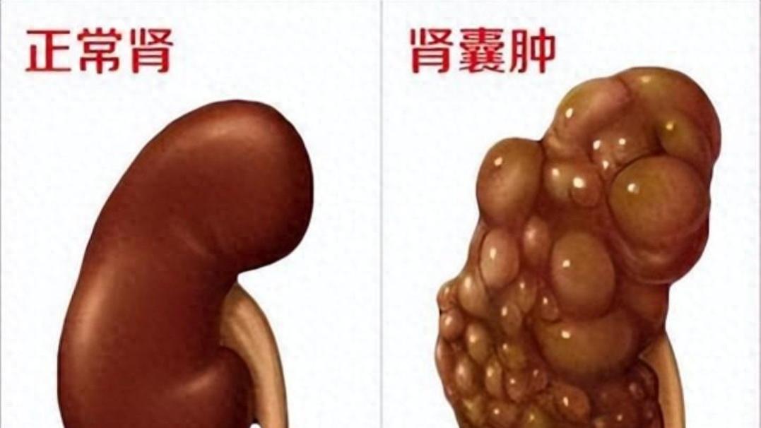 肾囊肿用艾灸调理效果很好之二