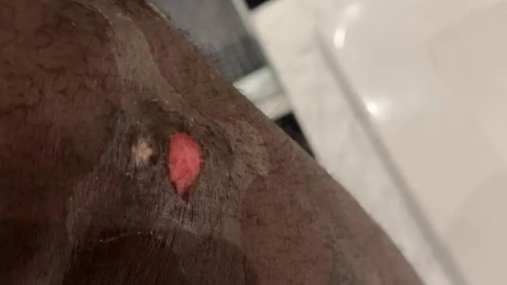 慎入！詹姆斯晒伤口！直呼好疼！老头太拼了