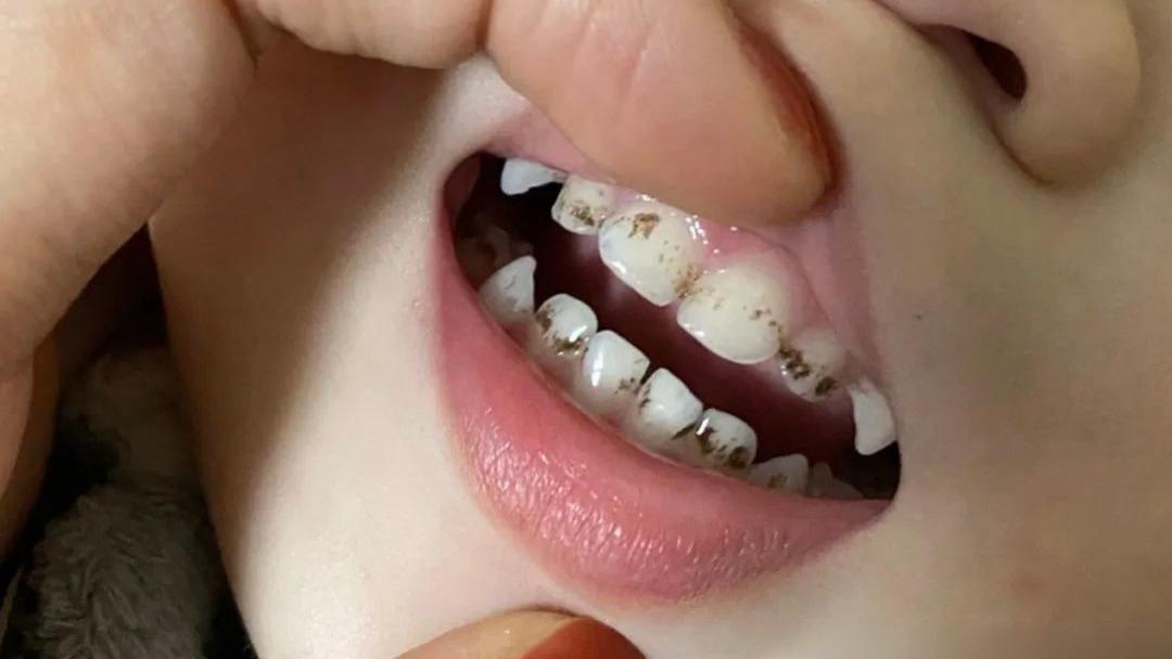 孩子牙齿上的小黑点，是蛀牙吗？真相和你想的不一样